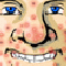  Acne Be Gone!